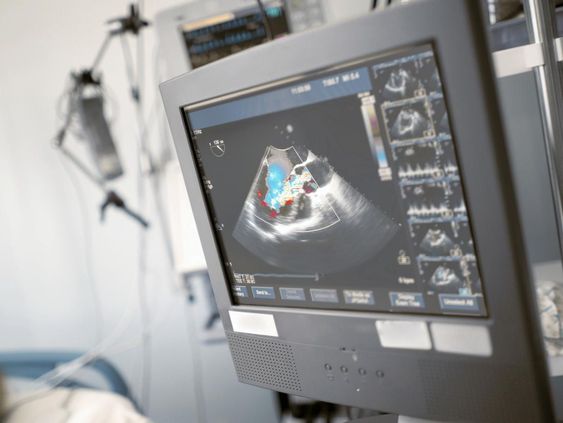 What an Echocardiogram Can Tell You About Your Heart